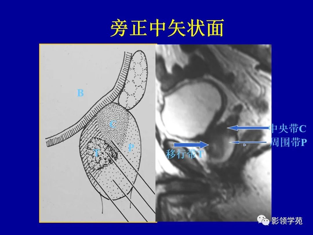 影像PPT - 【PPT】前列腺癌MRI诊断再认识-54