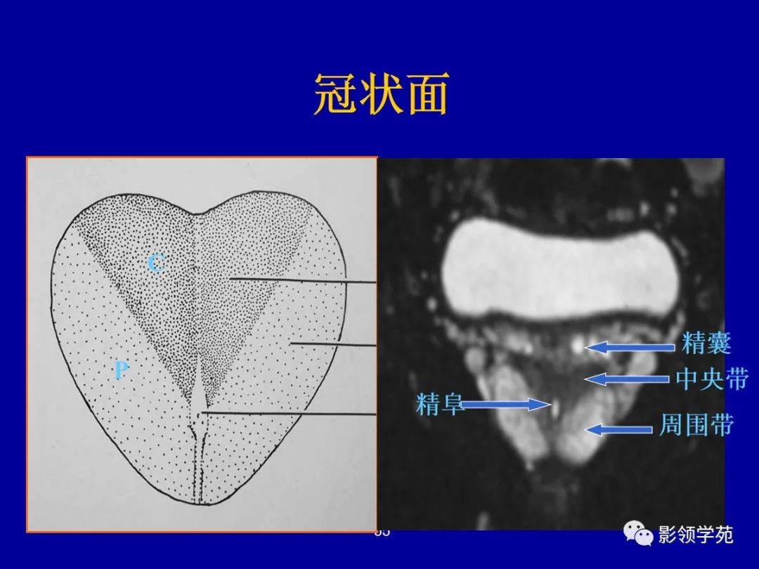 影像PPT - 【PPT】前列腺癌MRI诊断再认识-55