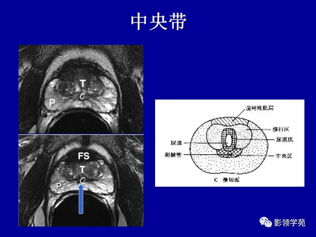 影像PPT - 【PPT】前列腺癌MRI诊断再认识-56