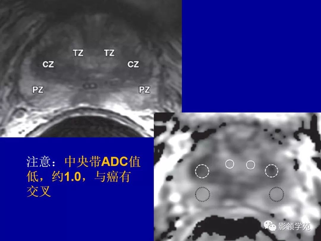 影像PPT - 【PPT】前列腺癌MRI诊断再认识-57
