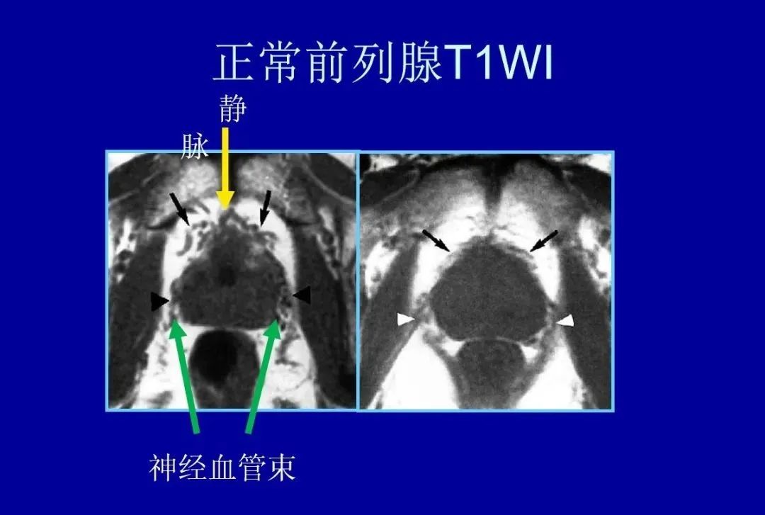 影像PPT - 【PPT】前列腺癌MRI诊断再认识-58
