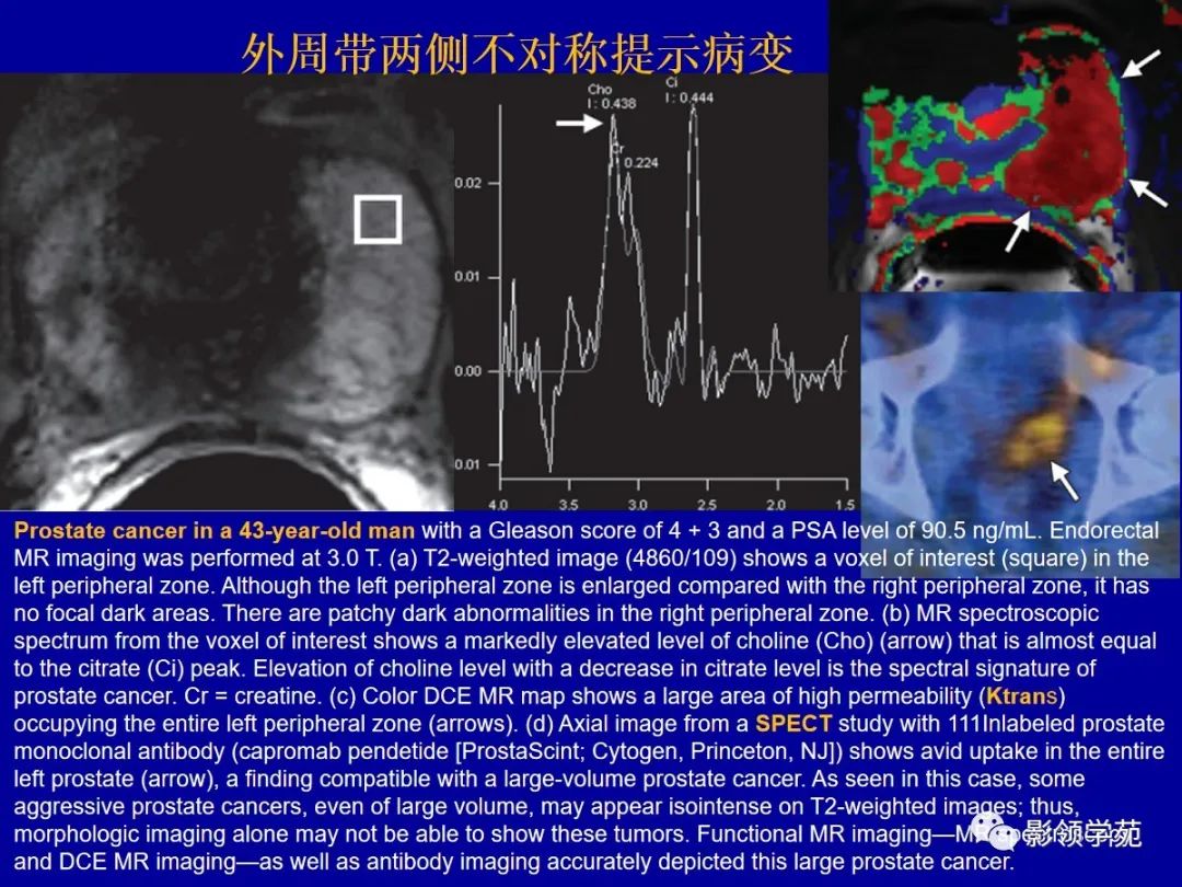 影像PPT - 【PPT】前列腺癌MRI诊断再认识-71