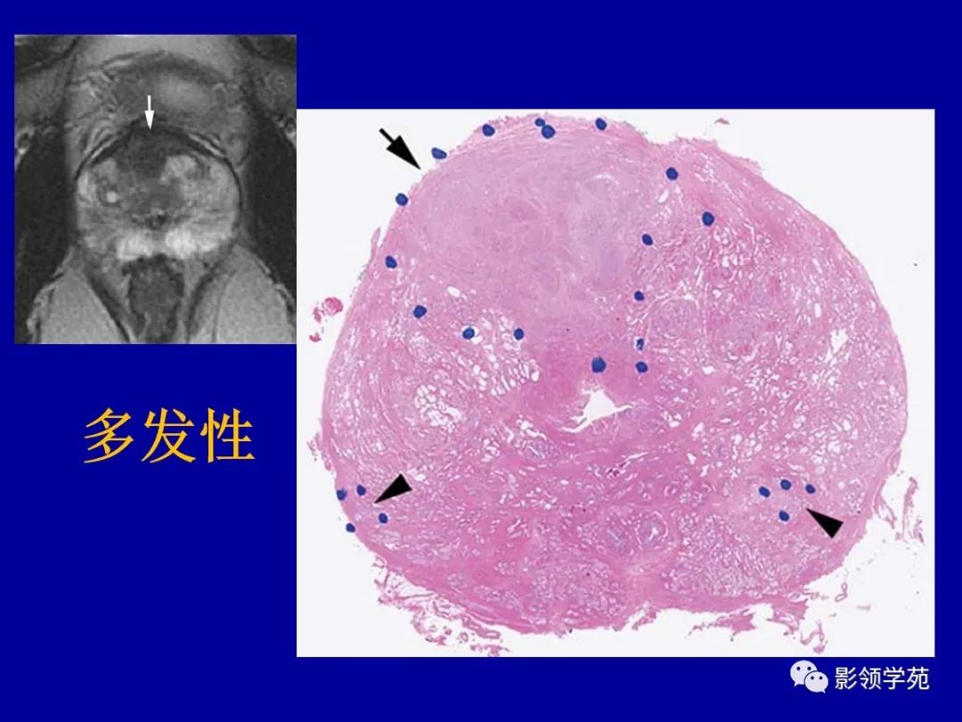 影像PPT - 【PPT】前列腺癌MRI诊断再认识-72
