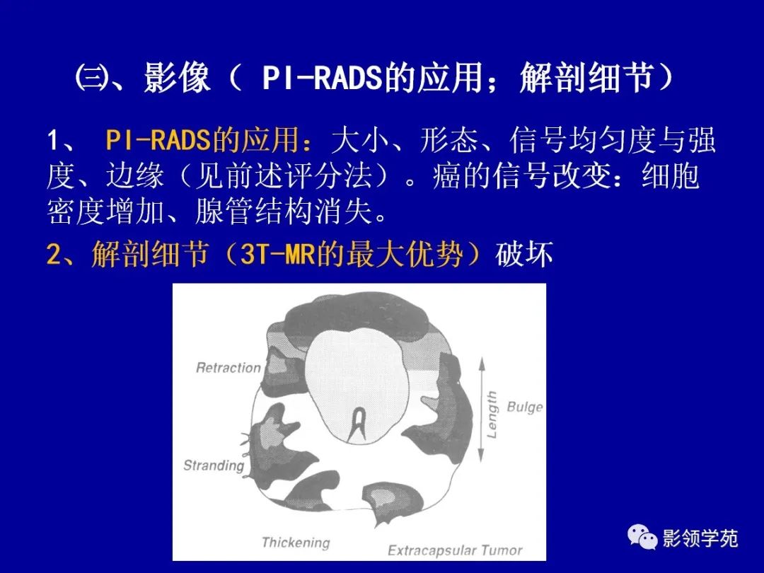 影像PPT - 【PPT】前列腺癌MRI诊断再认识-73