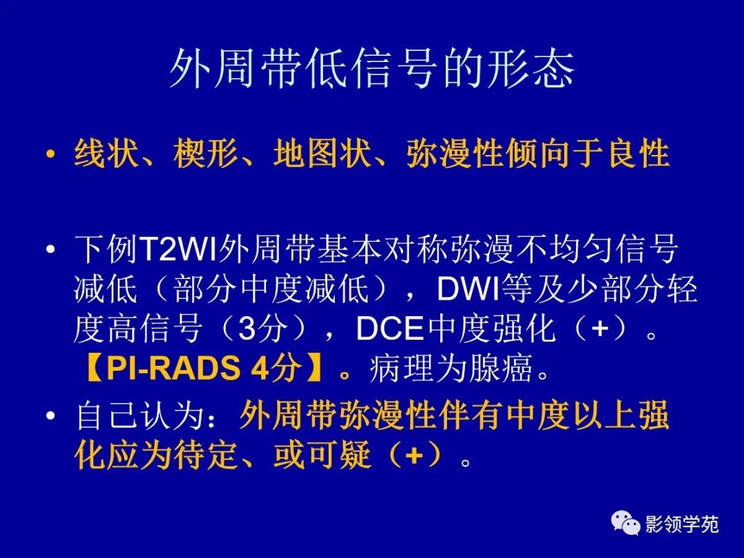 影像PPT - 【PPT】前列腺癌MRI诊断再认识-74