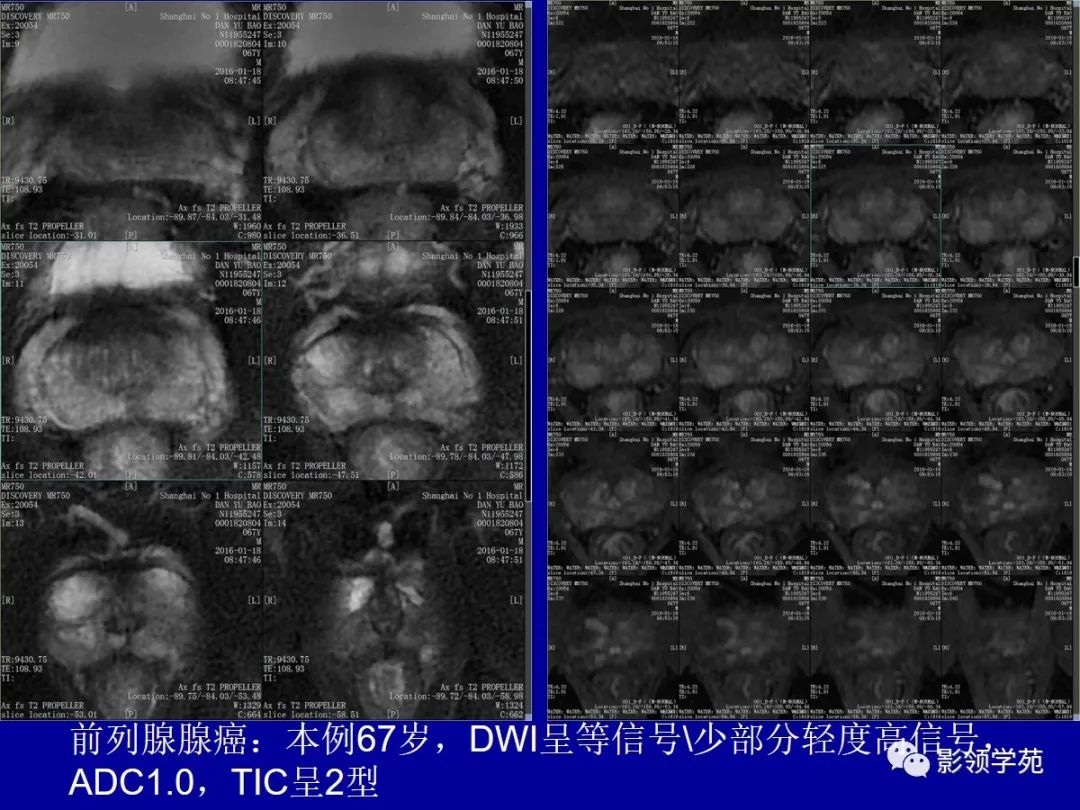 影像PPT - 【PPT】前列腺癌MRI诊断再认识-75