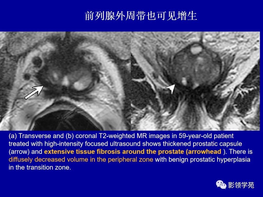 影像PPT - 【PPT】前列腺癌MRI诊断再认识-76