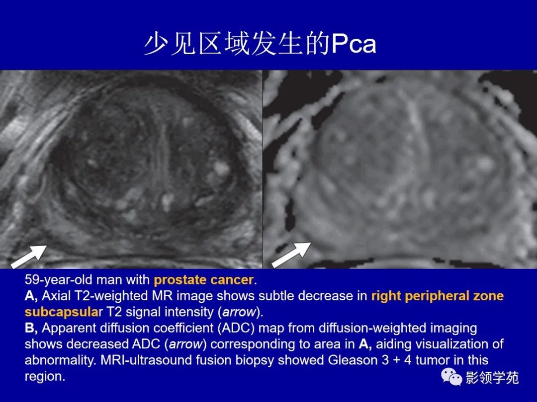 影像PPT - 【PPT】前列腺癌MRI诊断再认识-78