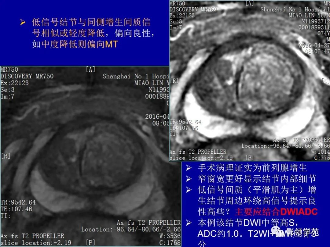 影像PPT - 【PPT】前列腺癌MRI诊断再认识-83