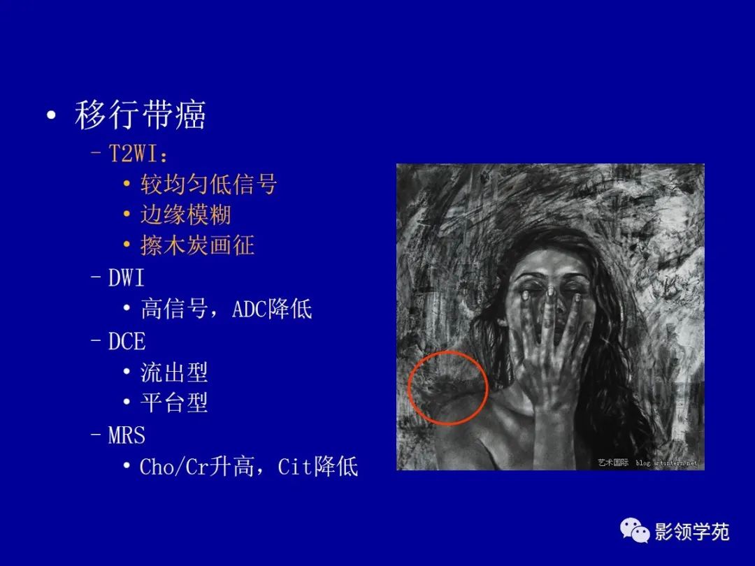 影像PPT - 【PPT】前列腺癌MRI诊断再认识-85