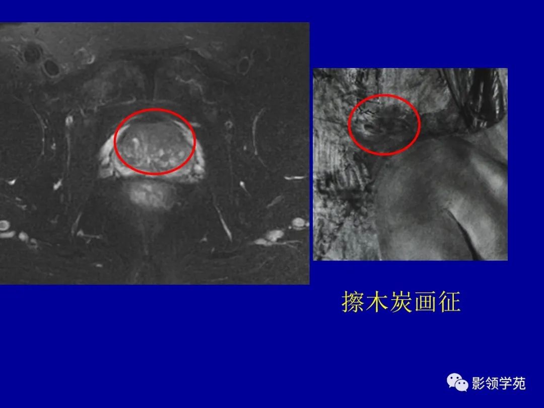 影像PPT - 【PPT】前列腺癌MRI诊断再认识-86