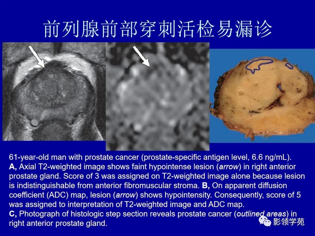 影像PPT - 【PPT】前列腺癌MRI诊断再认识-87