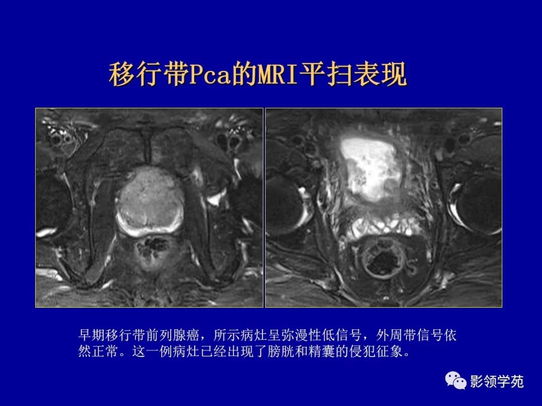影像PPT - 【PPT】前列腺癌MRI诊断再认识-91