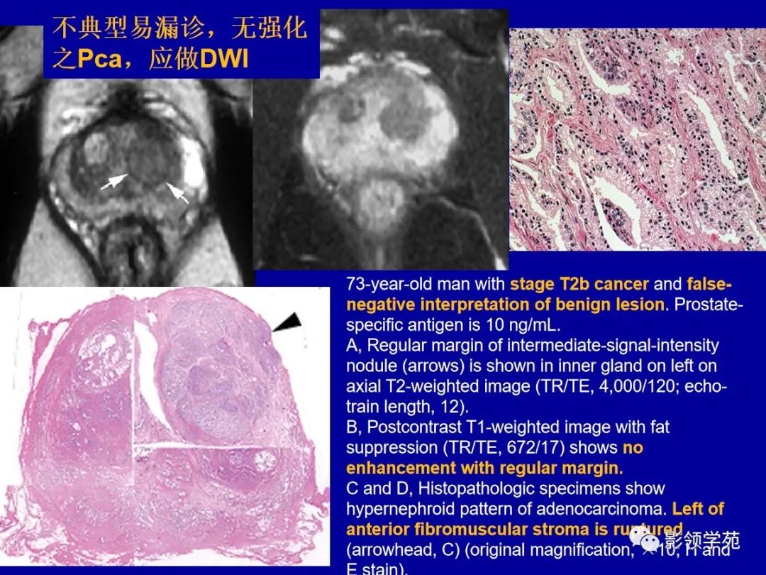 影像PPT - 【PPT】前列腺癌MRI诊断再认识-97