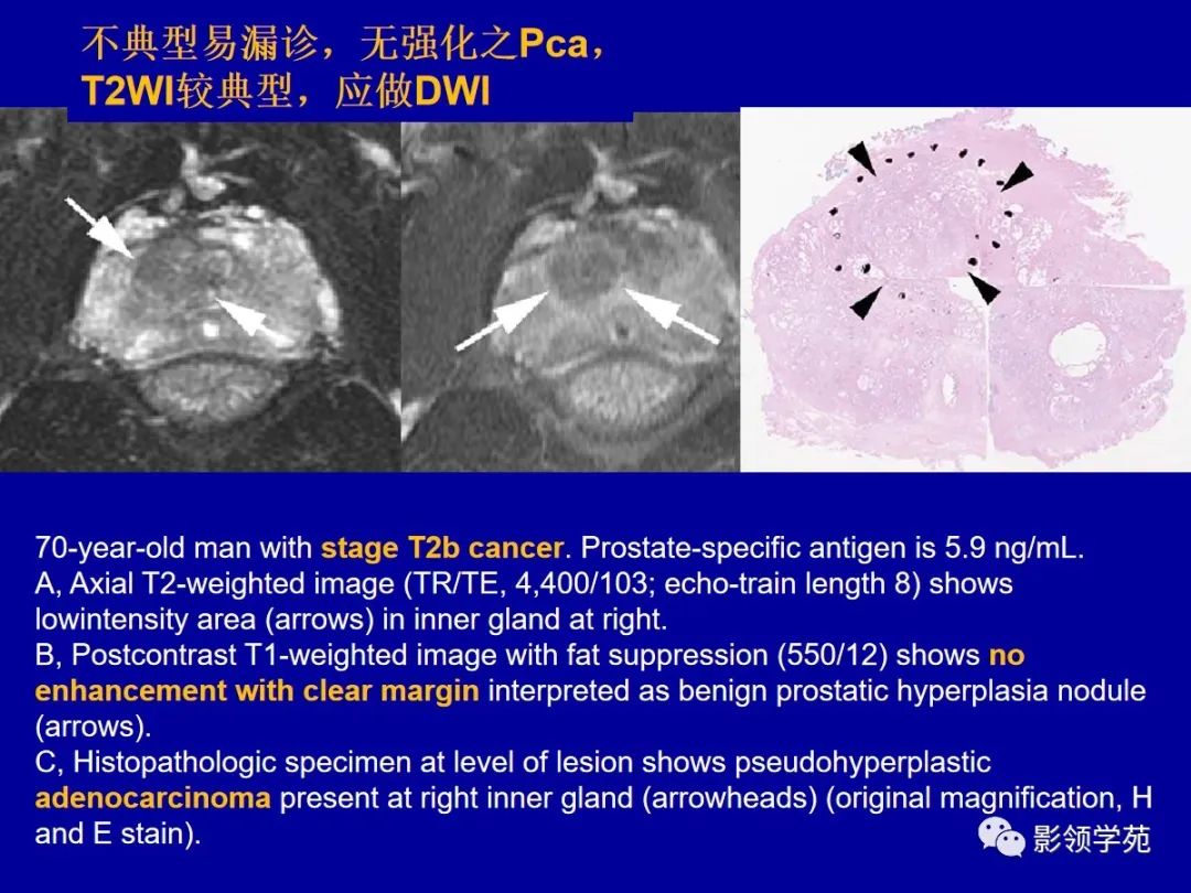 影像PPT - 【PPT】前列腺癌MRI诊断再认识-98