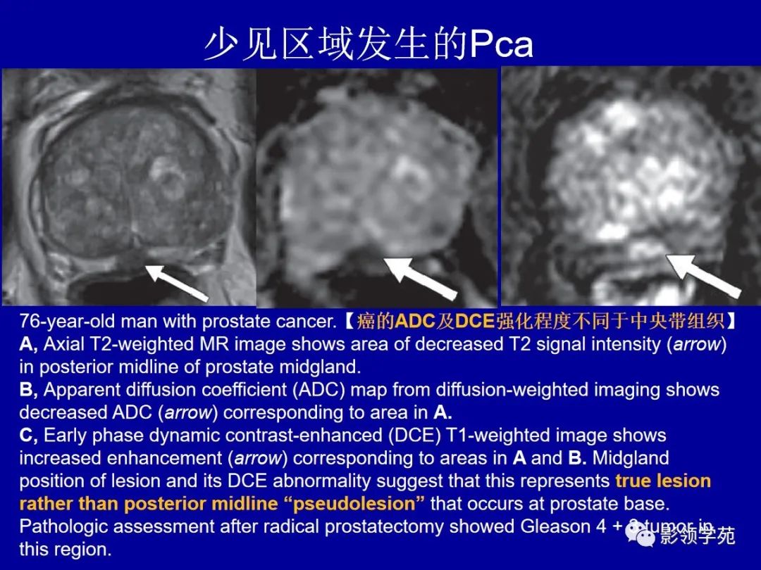 影像PPT - 【PPT】前列腺癌MRI诊断再认识-103