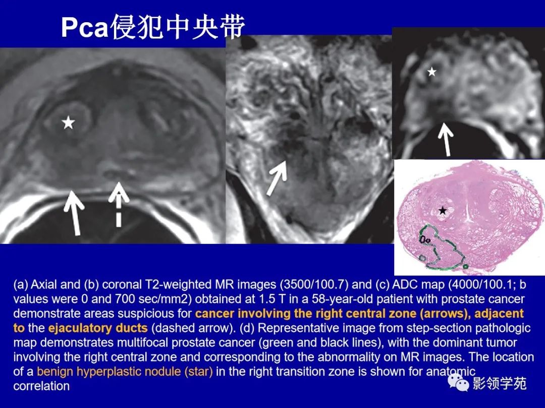 影像PPT - 【PPT】前列腺癌MRI诊断再认识-102