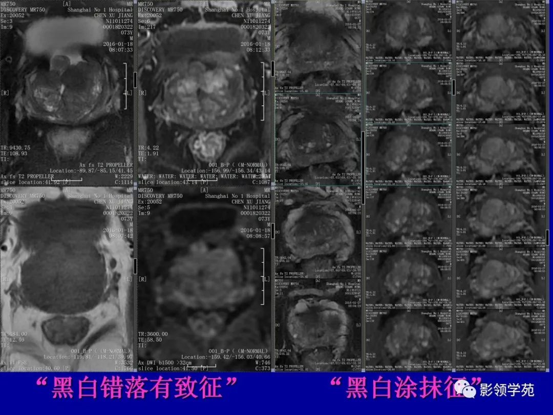 影像PPT - 【PPT】前列腺癌MRI诊断再认识-110