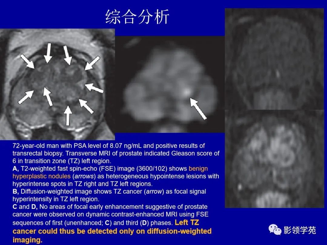 影像PPT - 【PPT】前列腺癌MRI诊断再认识-114