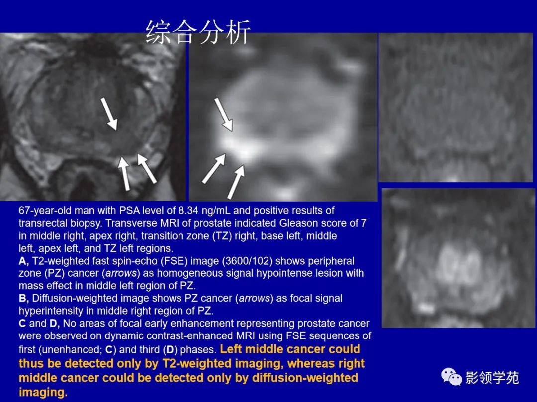 影像PPT - 【PPT】前列腺癌MRI诊断再认识-113