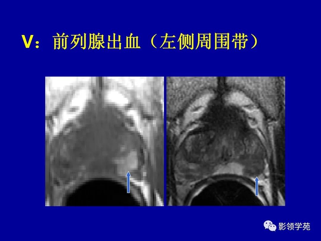 影像PPT - 【PPT】前列腺癌MRI诊断再认识-132