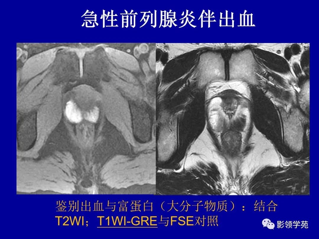 影像PPT - 【PPT】前列腺癌MRI诊断再认识-133