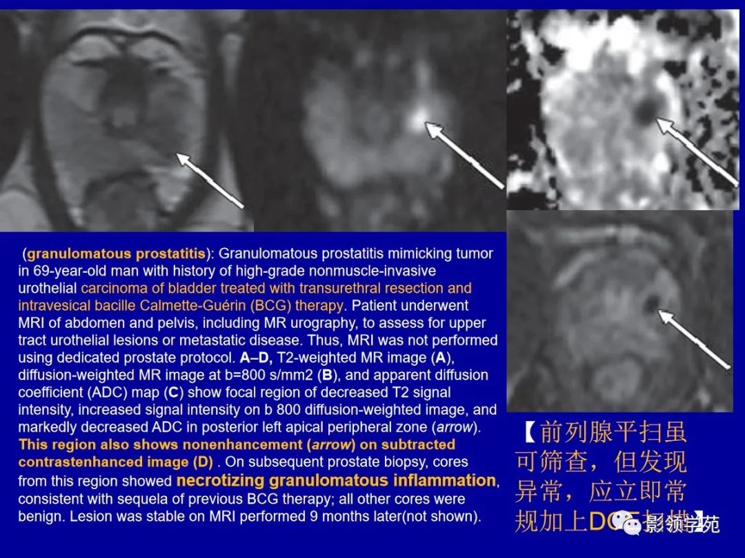 影像PPT - 【PPT】前列腺癌MRI诊断再认识-139