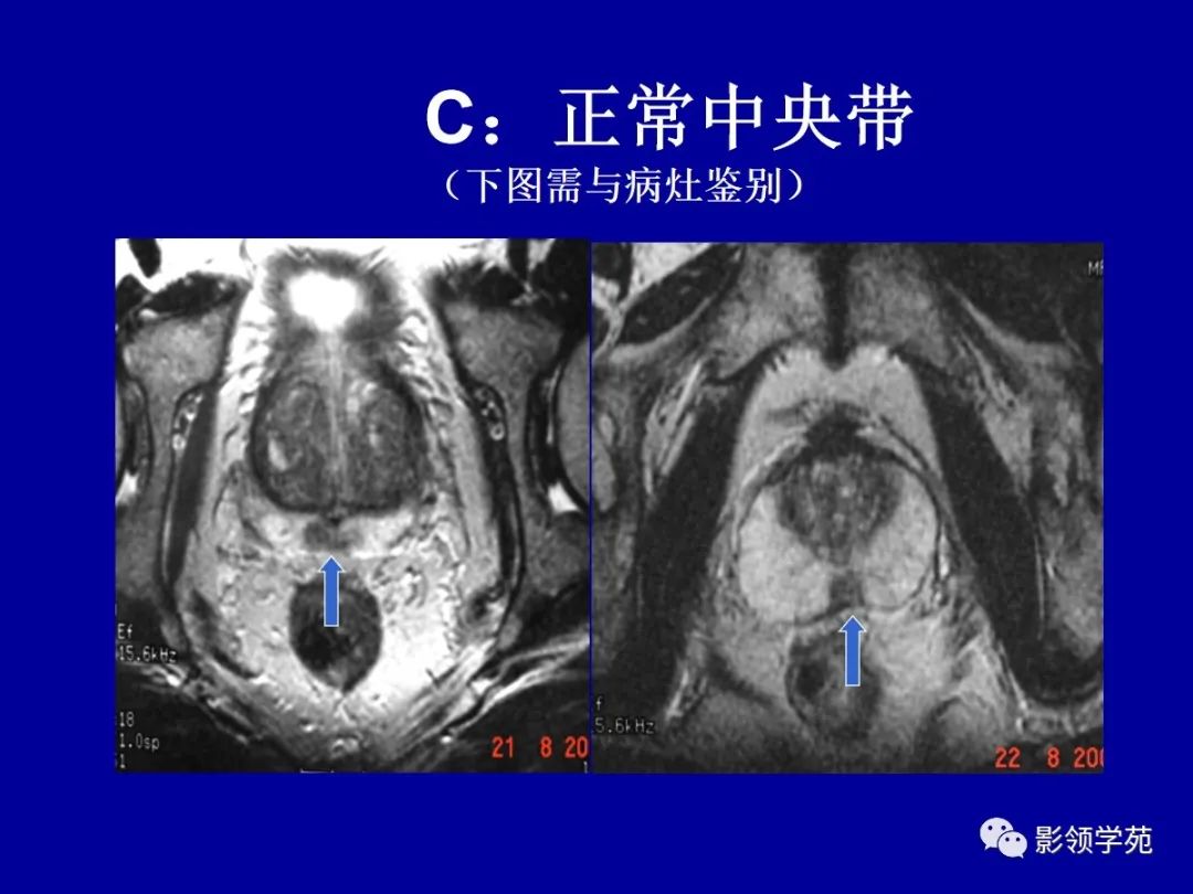 影像PPT - 【PPT】前列腺癌MRI诊断再认识-140