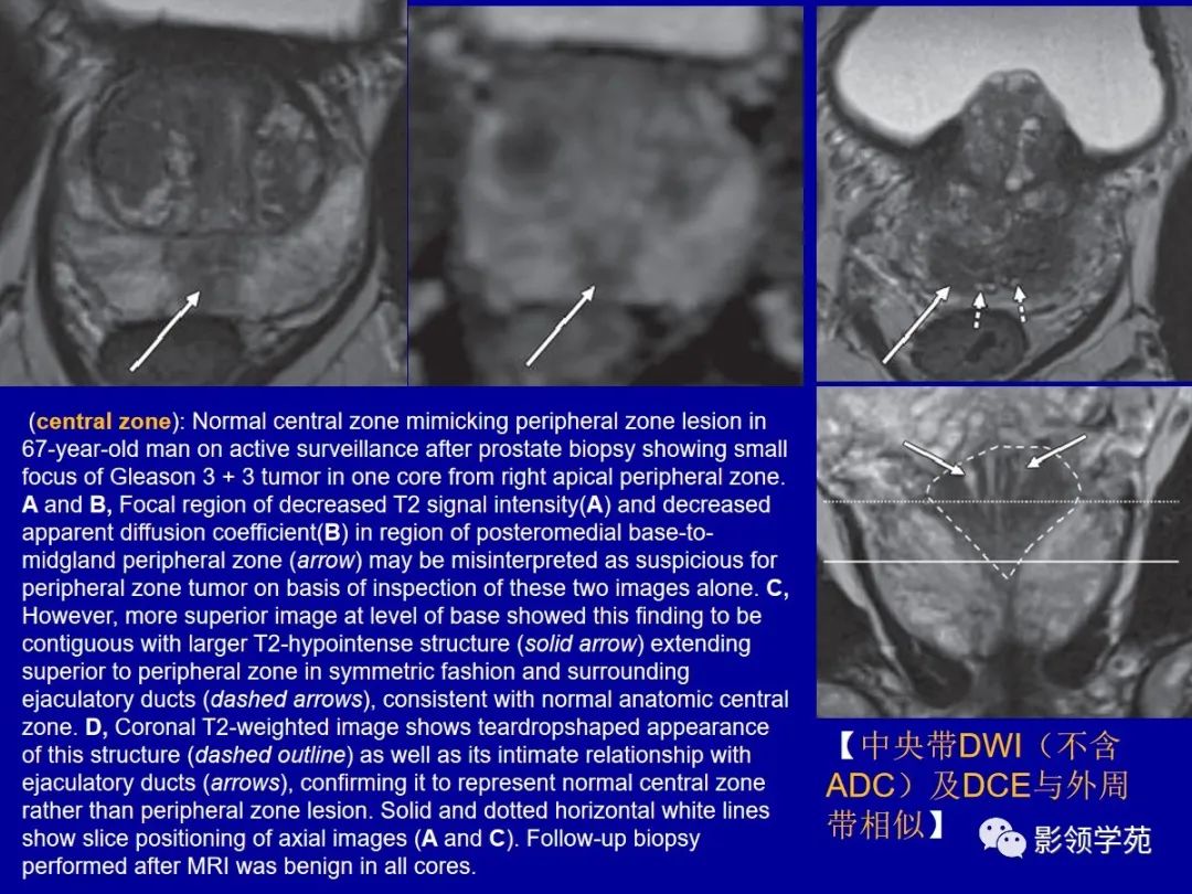 影像PPT - 【PPT】前列腺癌MRI诊断再认识-141