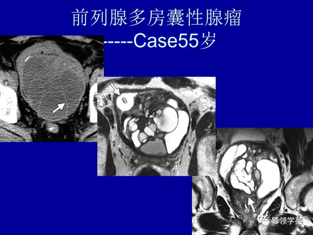 影像PPT - 【PPT】前列腺癌MRI诊断再认识-147