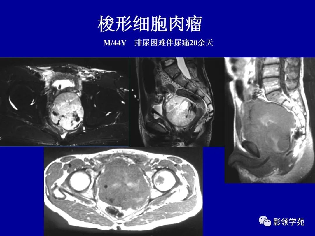 影像PPT - 【PPT】前列腺癌MRI诊断再认识-155