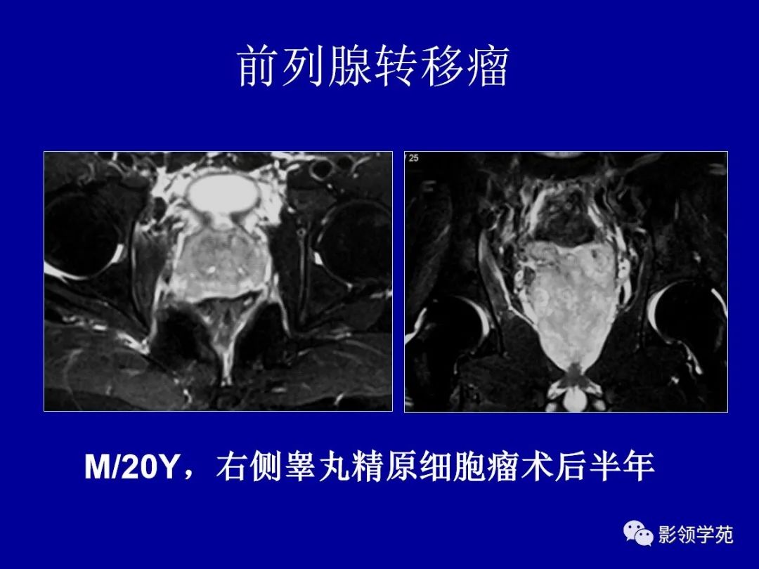 影像PPT - 【PPT】前列腺癌MRI诊断再认识-157