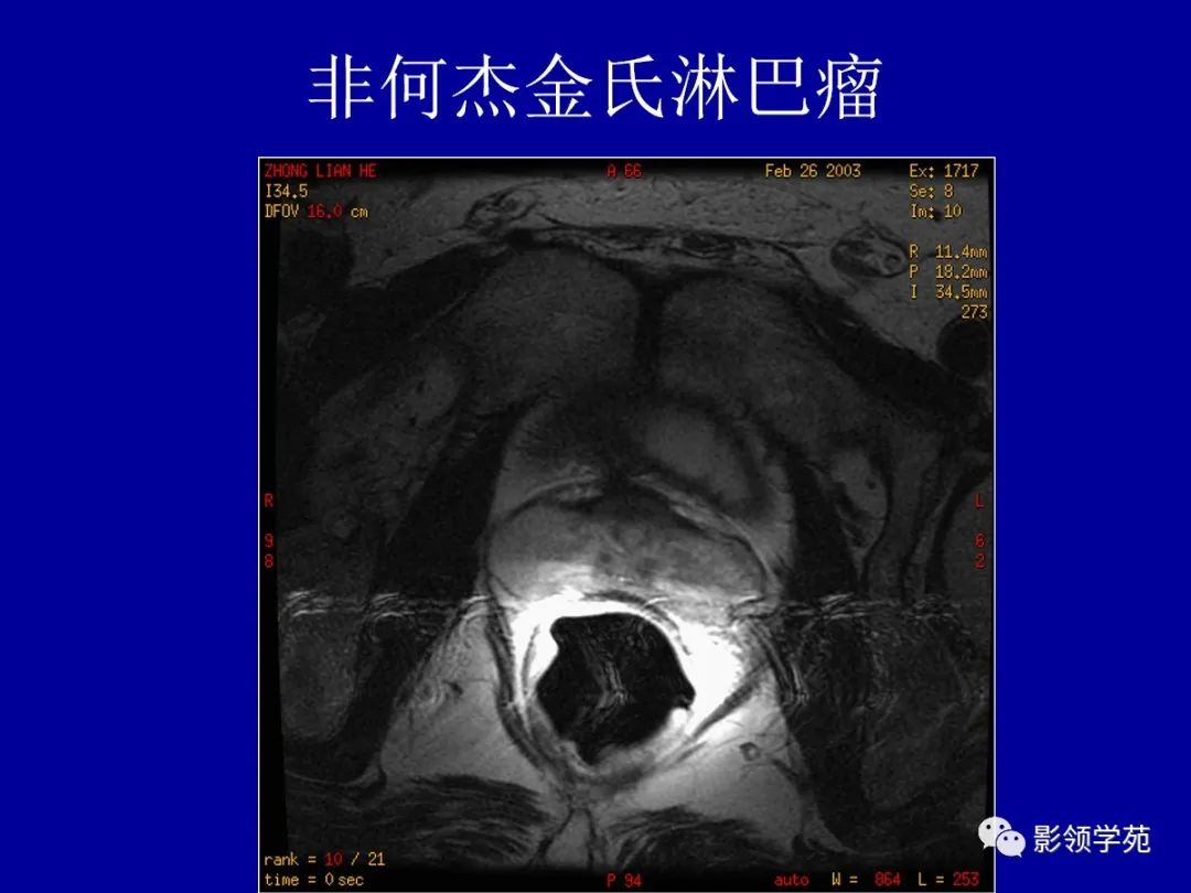 影像PPT - 【PPT】前列腺癌MRI诊断再认识-156