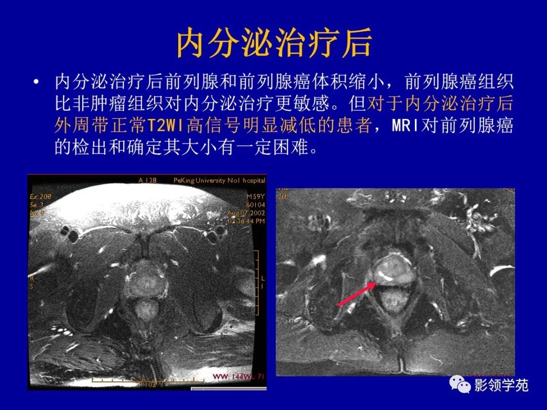 影像PPT - 【PPT】前列腺癌MRI诊断再认识-167