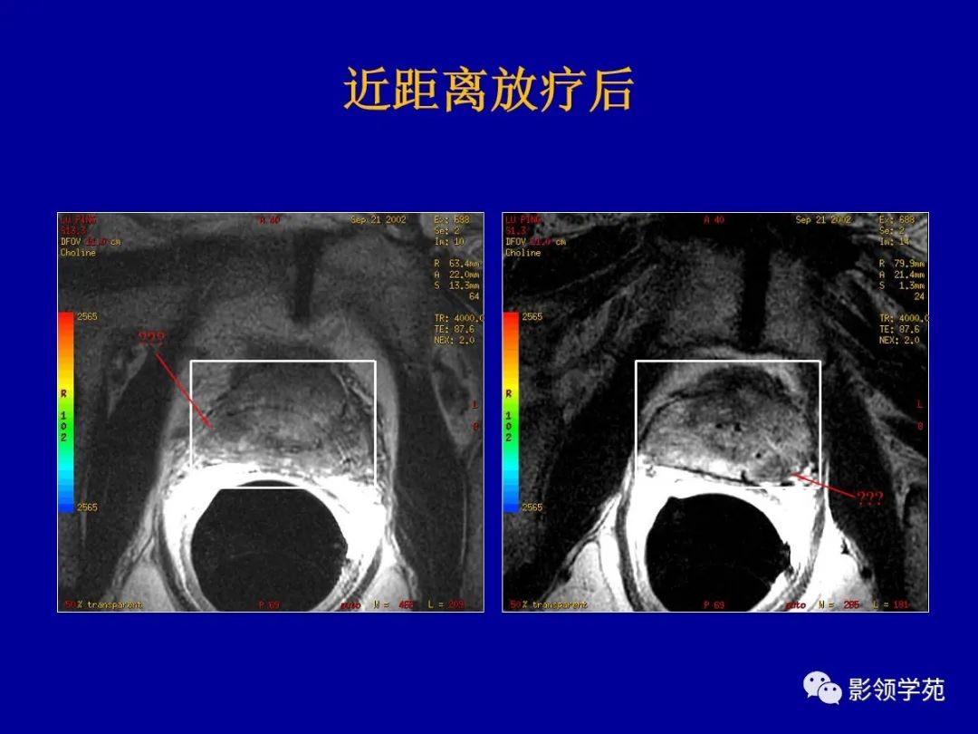 影像PPT - 【PPT】前列腺癌MRI诊断再认识-168