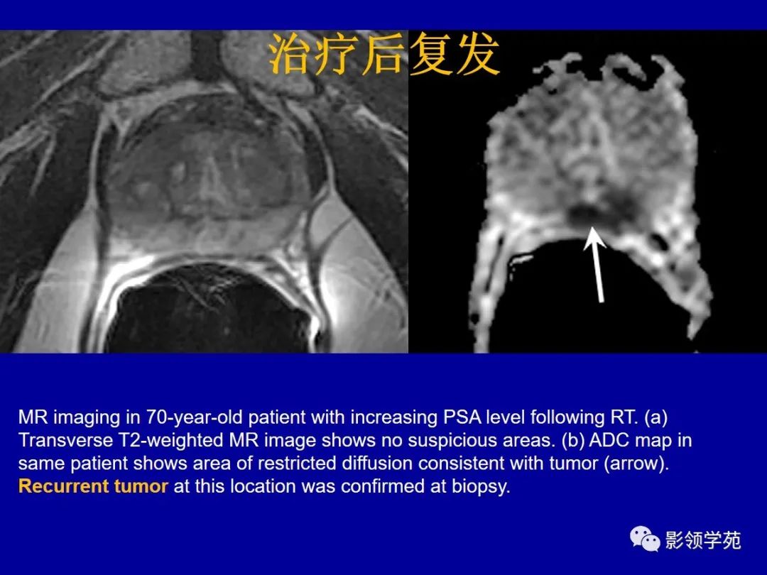 影像PPT - 【PPT】前列腺癌MRI诊断再认识-169