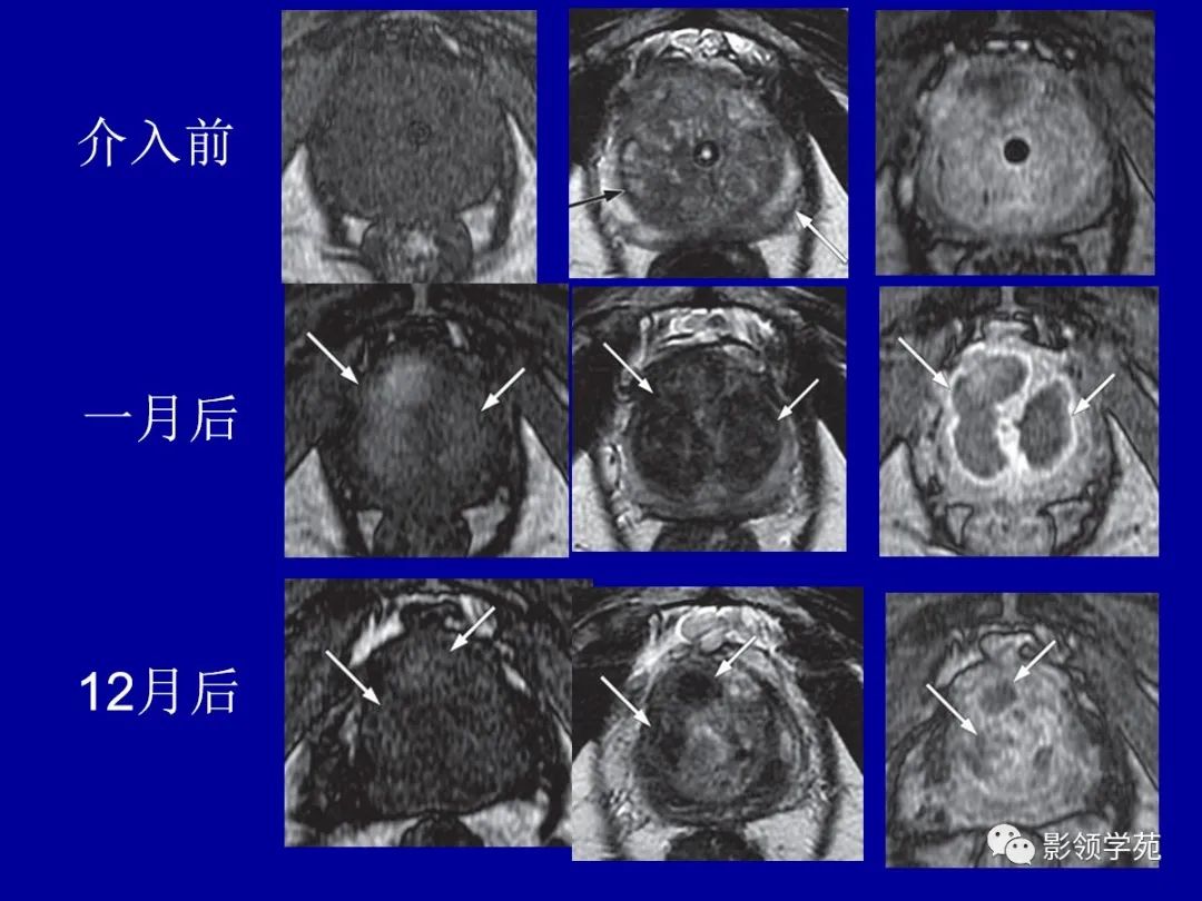 影像PPT - 【PPT】前列腺癌MRI诊断再认识-171