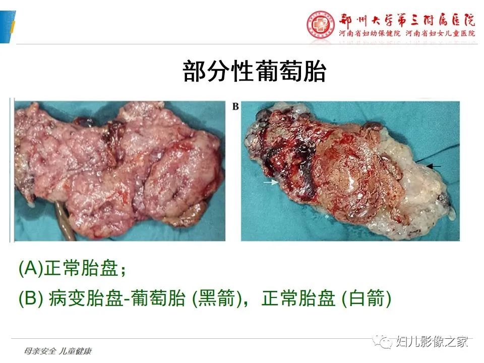 影像PPT - 【PPT】滋养细胞疾病CT/MR诊断-8