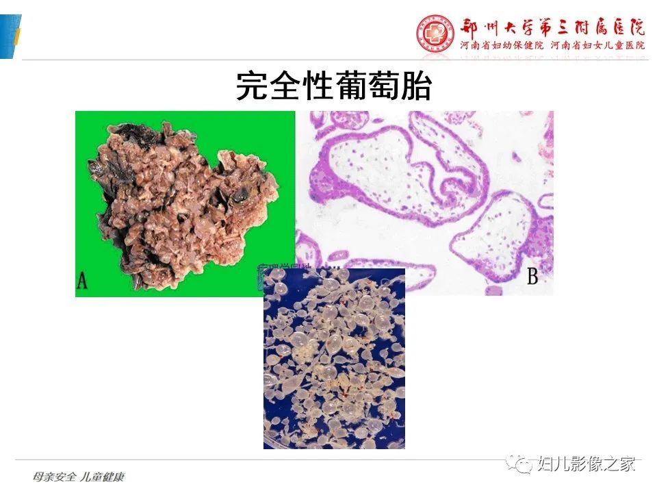 影像PPT - 【PPT】滋养细胞疾病CT/MR诊断-7