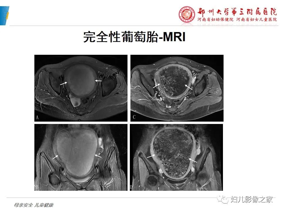 影像PPT - 【PPT】滋养细胞疾病CT/MR诊断-14