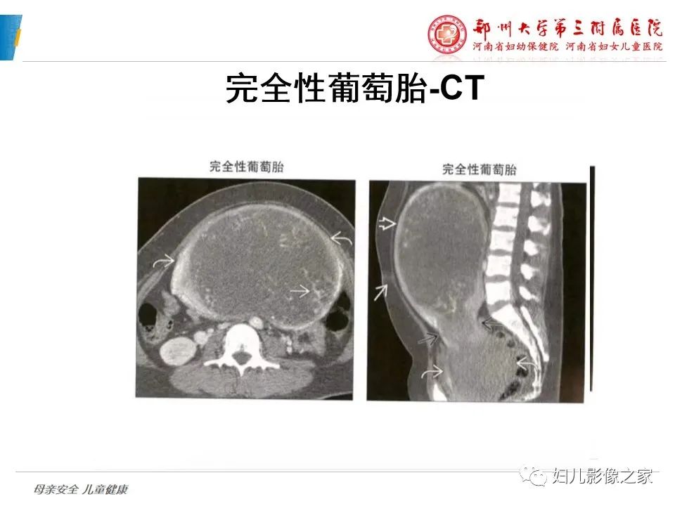 影像PPT - 【PPT】滋养细胞疾病CT/MR诊断-12