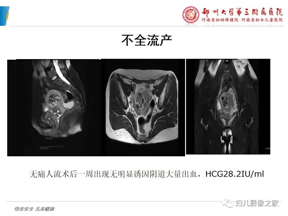 影像PPT - 【PPT】滋养细胞疾病CT/MR诊断-16