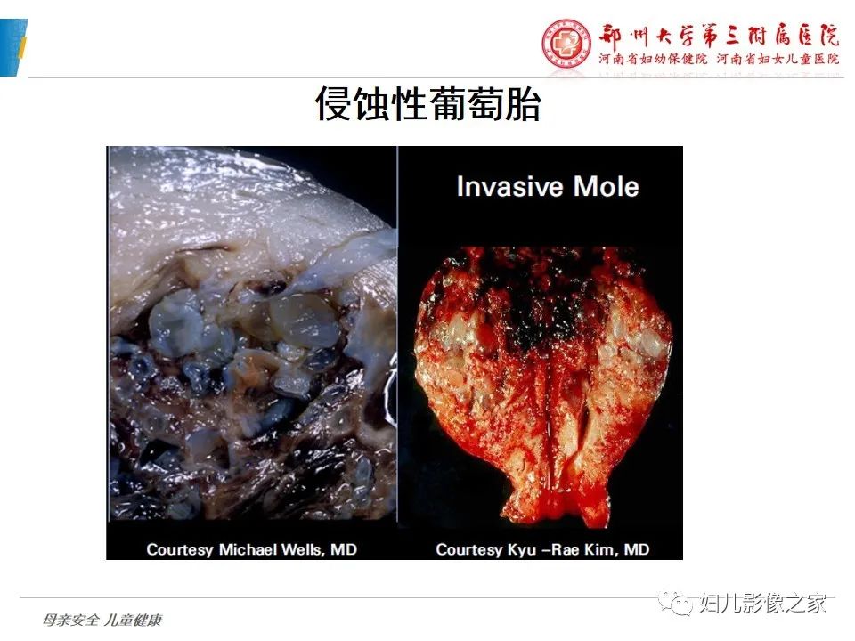 影像PPT - 【PPT】滋养细胞疾病CT/MR诊断-19