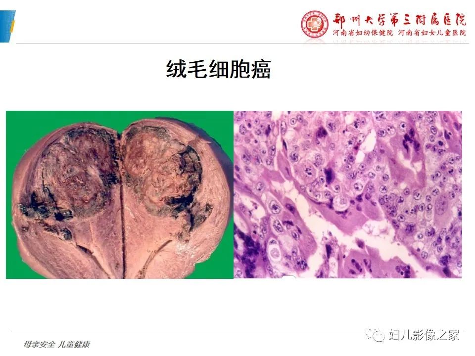 影像PPT - 【PPT】滋养细胞疾病CT/MR诊断-20