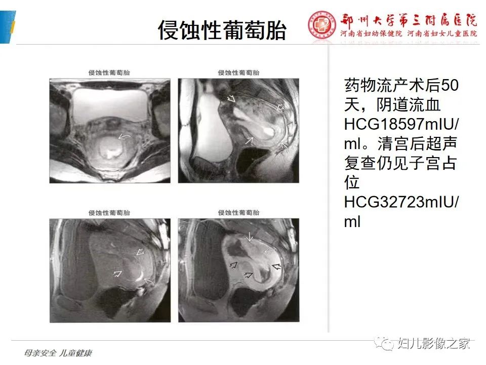 影像PPT - 【PPT】滋养细胞疾病CT/MR诊断-23