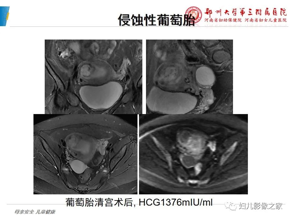影像PPT - 【PPT】滋养细胞疾病CT/MR诊断-24