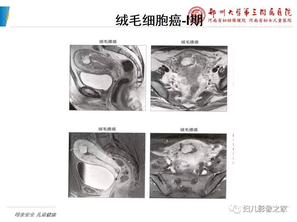 影像PPT - 【PPT】滋养细胞疾病CT/MR诊断-26