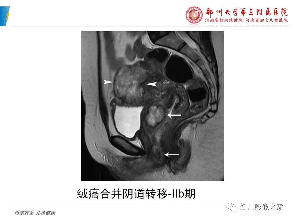 影像PPT - 【PPT】滋养细胞疾病CT/MR诊断-27
