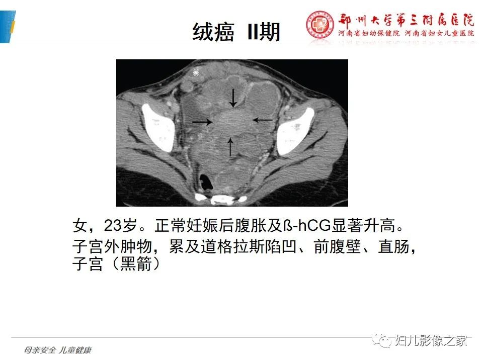 影像PPT - 【PPT】滋养细胞疾病CT/MR诊断-28