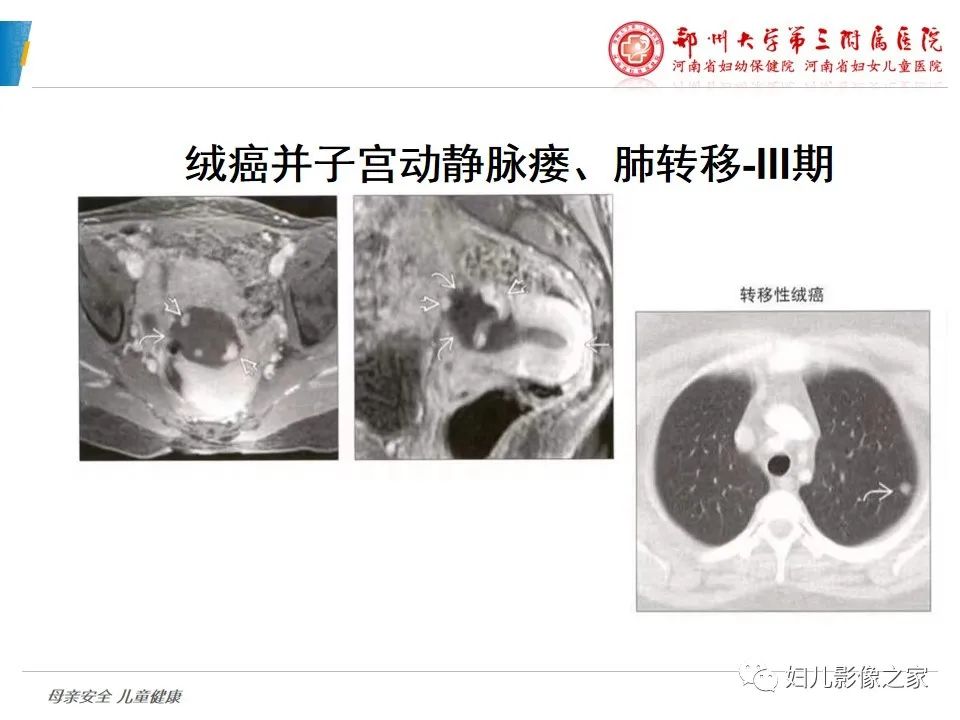 影像PPT - 【PPT】滋养细胞疾病CT/MR诊断-29